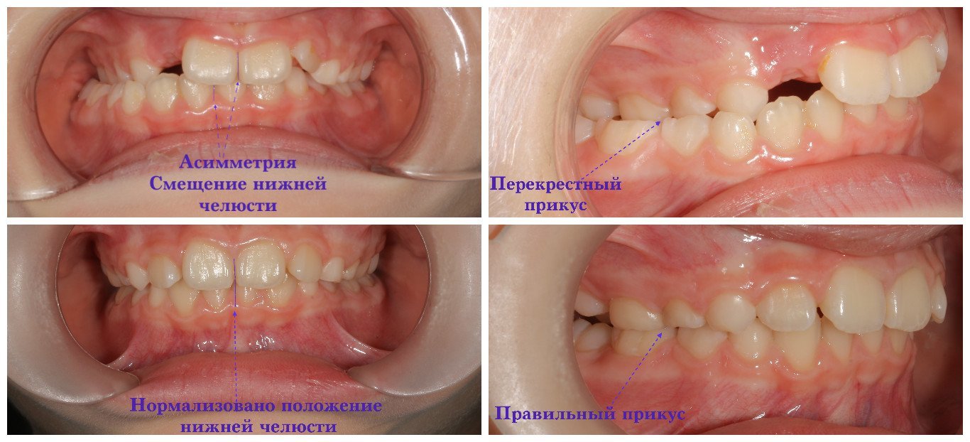 Фото зубов на имплантах верхней челюсти